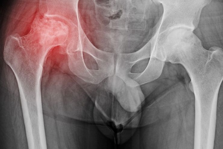 AVN Hip Replacement