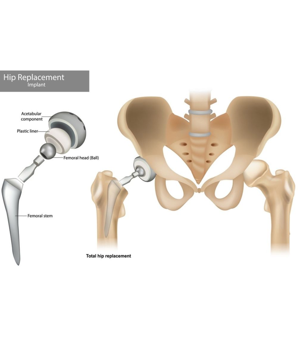 total Hip Replacement