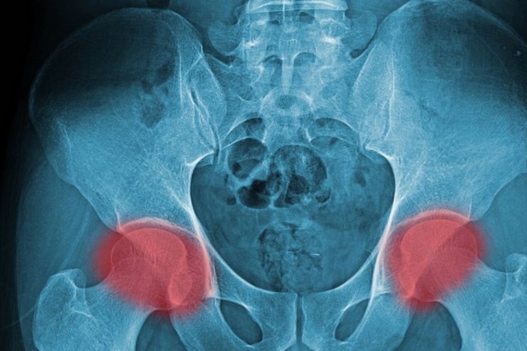 xray image male pelvis neck femur