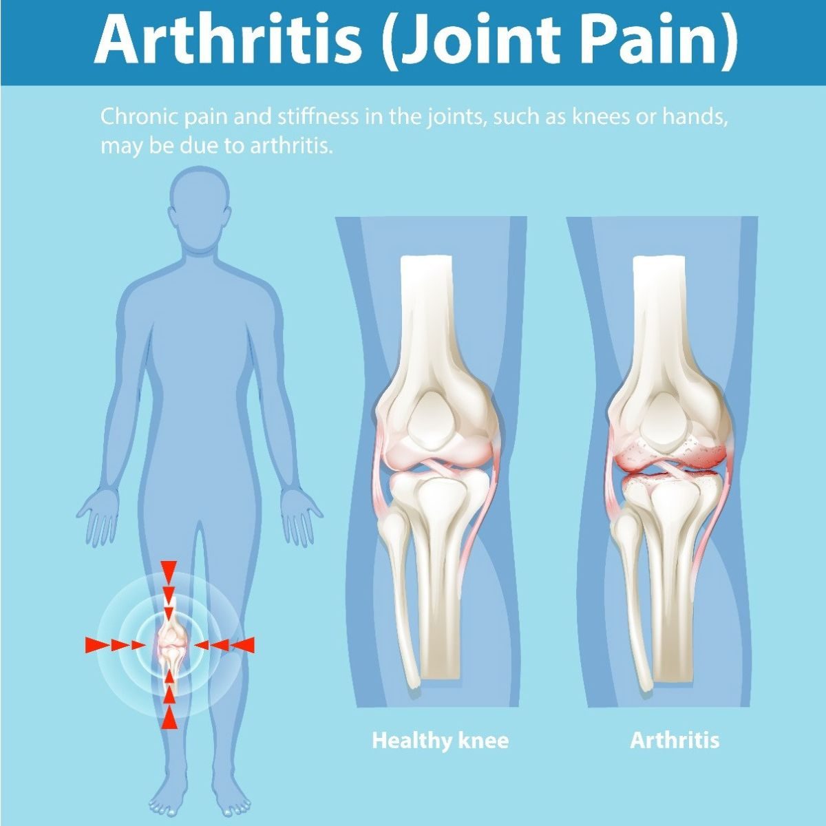 Arthritis (Joint Pain)