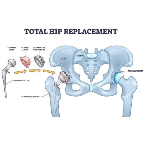 Total hip replacement surgery - Dr. Rakesh Verma